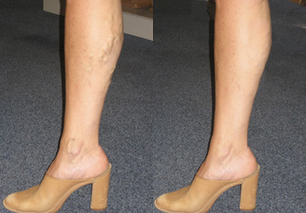 how to prevent varicose how to prevent varicose